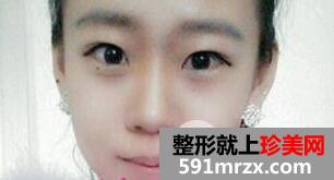 韩式切开法双眼皮手术全过程附前后恢复对比图片