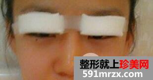 韩式切开法双眼皮手术全过程附前后恢复对比图片