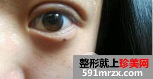 韩式切开法双眼皮手术全过程附前后恢复对比图片