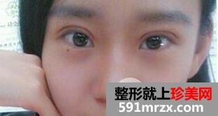韩式切开法双眼皮手术全过程附前后恢复对比图片
