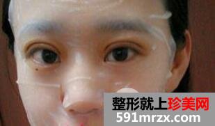 韩式切开法双眼皮手术全过程附前后恢复对比图片