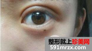 韩式切开法双眼皮手术全过程附前后恢复对比图片