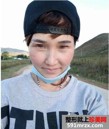 全面部自体脂肪填充手术后效果怎么样前后对比照