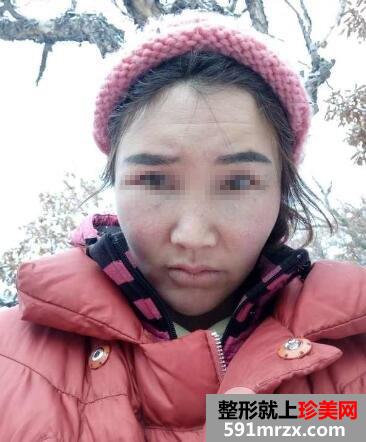 全面部自体脂肪填充手术后效果怎么样前后对比照