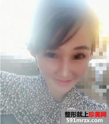 全面部自体脂肪填充手术后效果怎么样前后对比照