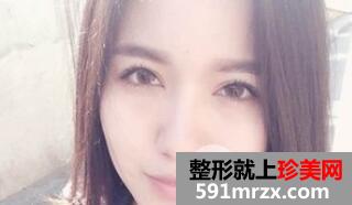 全切双眼皮7mm+开眼角整形手术效果图恢复全过程
