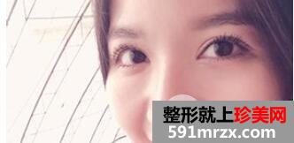全切双眼皮7mm+开眼角整形手术效果图恢复全过程