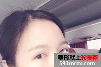 全切双眼皮7mm+开眼角整形手术效果图恢复全过程
