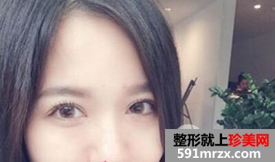 全切双眼皮7mm+开眼角整形手术效果图恢复全过程