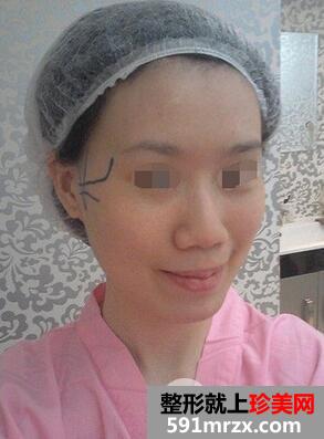 削骨磨腮手术全过程亲身经历分享效果前后对比图