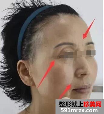 botox生物除皱效果如何大揭密附注射前后对比图
