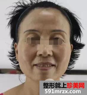 botox生物除皱效果如何大揭密附注射前后对比图