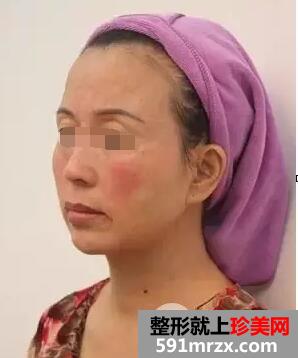 botox生物除皱效果如何大揭密附注射前后对比图