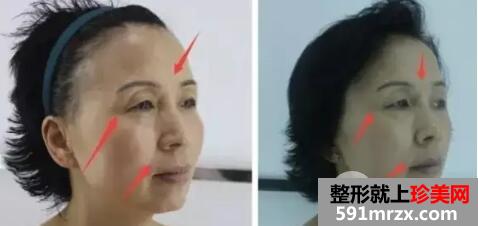 botox生物除皱效果如何大揭密附注射前后对比图