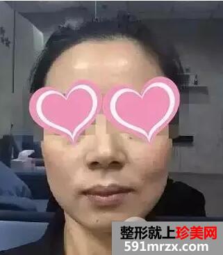 注射水光针效果图前后对比亲身体验皮肤水嫩