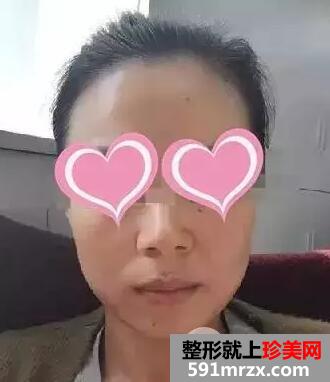 注射水光针效果图前后对比亲身体验皮肤水嫩