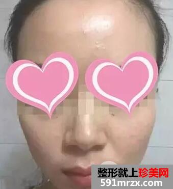 注射水光针效果图前后对比亲身体验皮肤水嫩