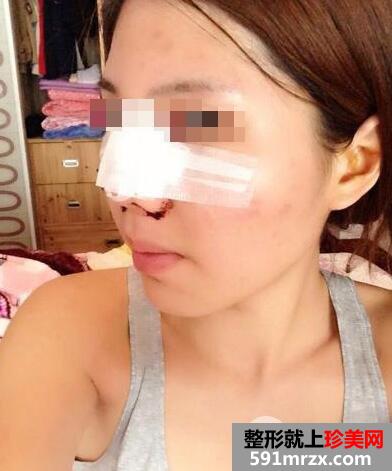 鼻头缩小手术案例恢复时间多久前后对比图
