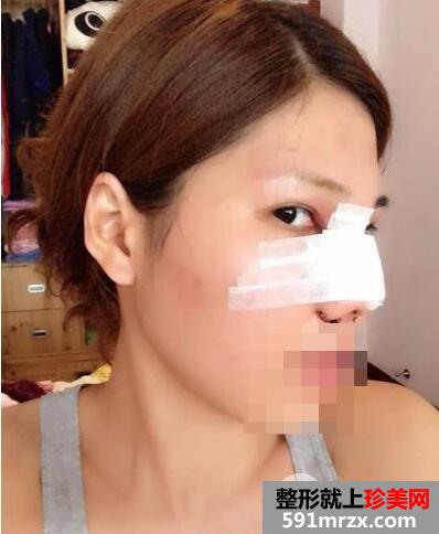 鼻头缩小手术案例恢复时间多久前后对比图