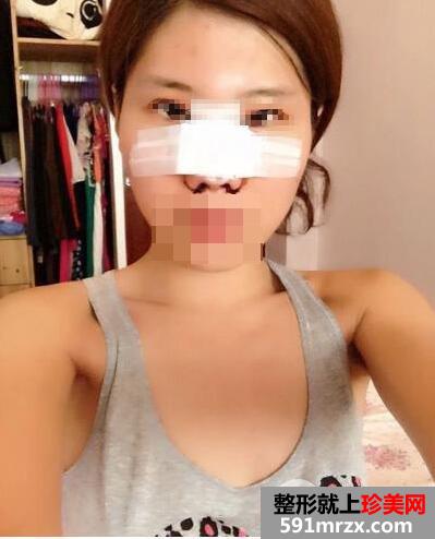 鼻头缩小手术案例恢复时间多久前后对比图