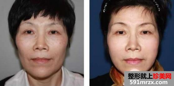瑞兰玻尿酸注射除皱术案例前后对比效果图