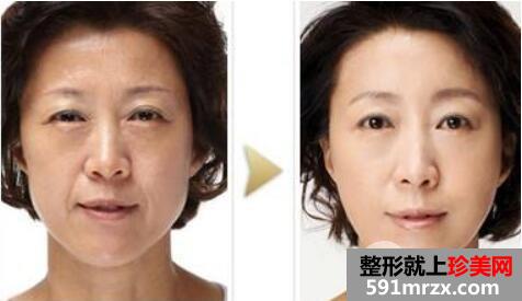 瑞兰玻尿酸注射除皱术案例前后对比效果图