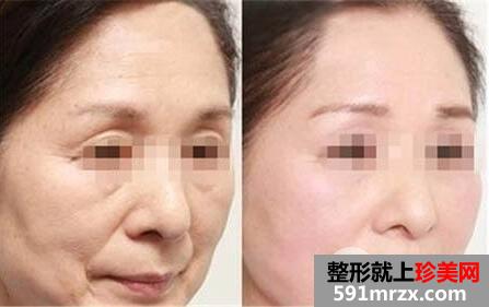 瑞兰玻尿酸注射除皱术案例前后对比效果图
