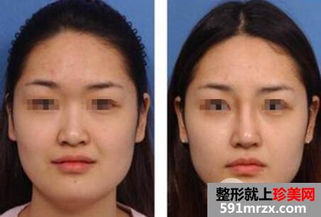 鼻头缩小手术价钱 鼻头缩小真实案例前后对比图