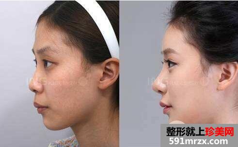 鼻头缩小手术价钱 鼻头缩小真实案例前后对比图