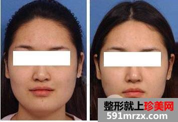 鼻头缩小手术价钱 鼻头缩小真实案例前后对比图