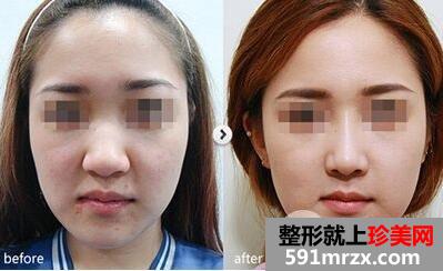 鼻头缩小手术价钱 鼻头缩小真实案例前后对比图