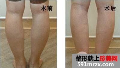 怎样让小腿变细 腿太粗可以做抽脂整形手术吗