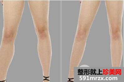 怎样让小腿变细 腿太粗可以做抽脂整形手术吗
