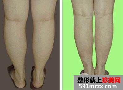 怎样让小腿变细 腿太粗可以做抽脂整形手术吗