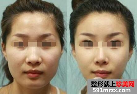 膨体隆下巴的效果好吗 膨体隆下巴整形真人案例对比图
