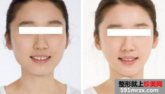 膨体隆下巴的效果好吗 膨体隆下巴整形真人案例对比图