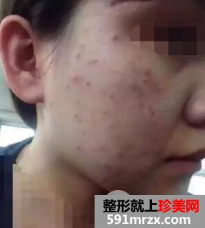 果酸换肤效果图 果酸换肤能维持多久真人案例
