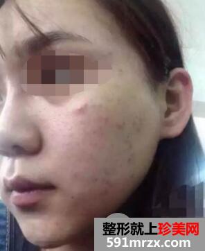 果酸换肤效果图 果酸换肤能维持多久真人案例
