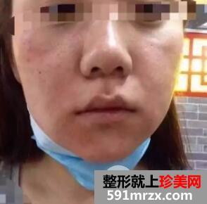 果酸换肤效果图 果酸换肤能维持多久真人案例