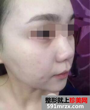 果酸换肤效果图 果酸换肤能维持多久真人案例