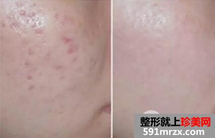 果酸换肤效果图 果酸换肤能维持多久真人案例