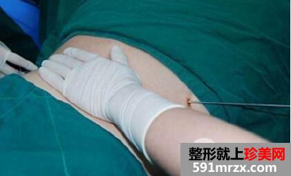 抽脂减肥全过程图片 抽脂整形手术效果怎么样