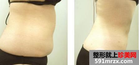 抽脂减肥全过程图片 抽脂整形手术效果怎么样