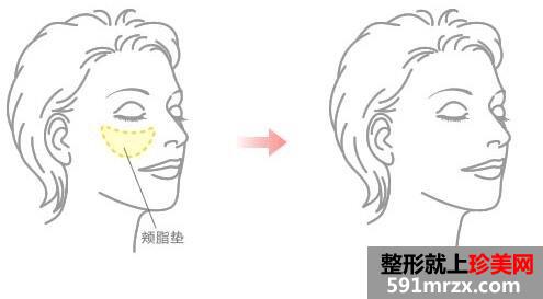 去颊脂垫效果怎么样 取颊脂垫手术前后对比照片