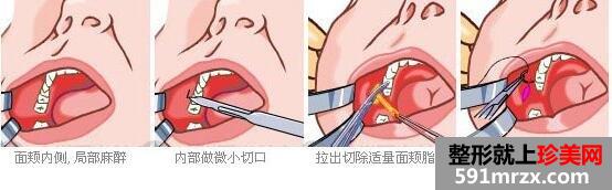去颊脂垫效果怎么样 取颊脂垫手术前后对比照片