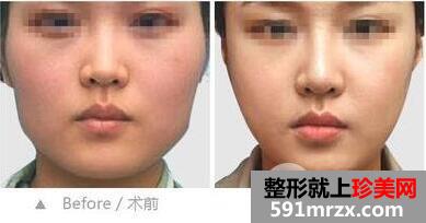 去颊脂垫效果怎么样 取颊脂垫手术前后对比照片