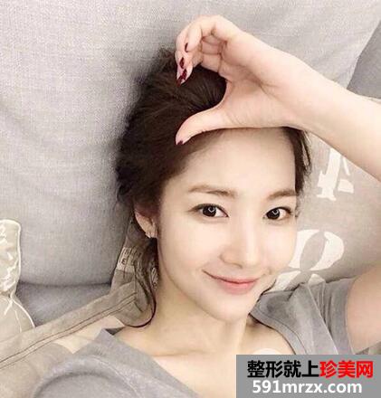 切开双眼皮能维持多久