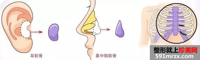 隆鼻最好用什么方法？教你选择适合自己的隆鼻方式