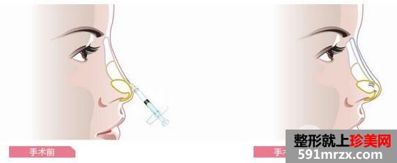 隆鼻最好用什么方法？教你选择适合自己的隆鼻方式