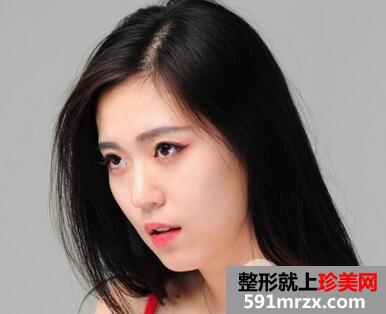 驼峰鼻的矫正方法是什么?
